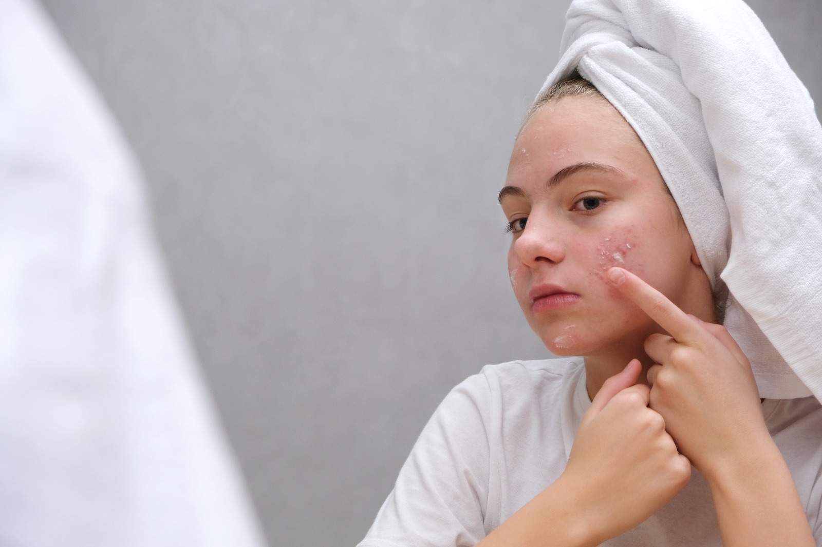 El acné juvenil – ¿Cómo cuidarlo?